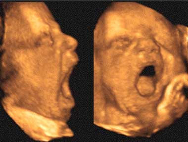  échographie-foetus-qui-baillent