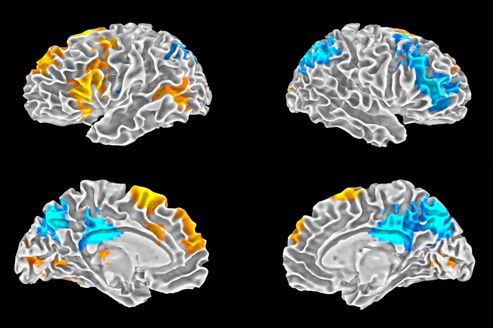 IRM-cerveau