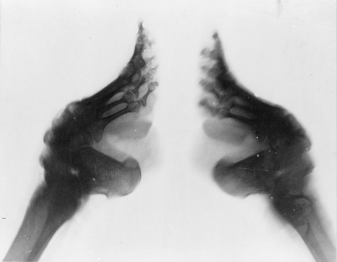 radiographie-pieds-bandés-chine