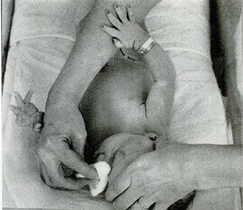 La nurse met le collyre antibactérien (type nitrate d’argent- afin de prévenir la syphilis. traitement préventif obligatoire.